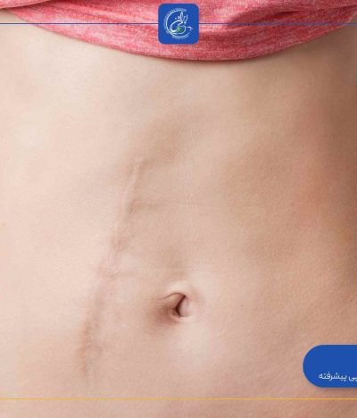 آیا جای بخیه بعد از جراحی لاغری باقی میماند؟
