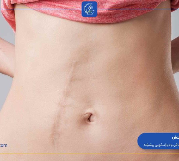 why-do-stitches-remain-after-weight-loss-surgery