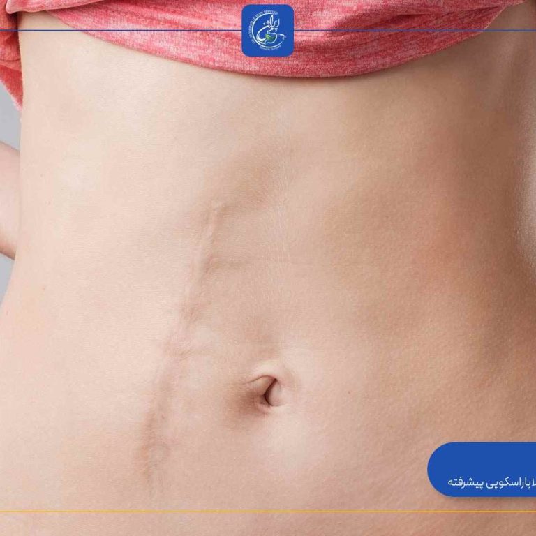 why-do-stitches-remain-after-weight-loss-surgery why-do-stitches-remain-after-weight-loss-surgery